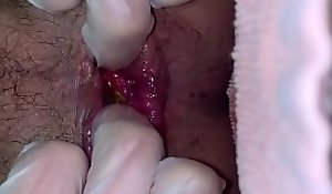 Self distension be fitting of anal butt-hole